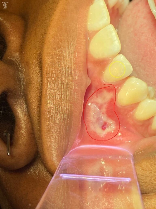 DIY tooth pull gone wrong