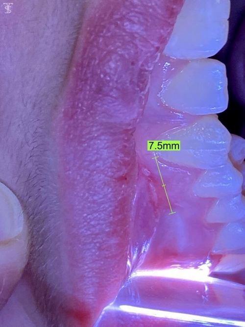 Oral lesion