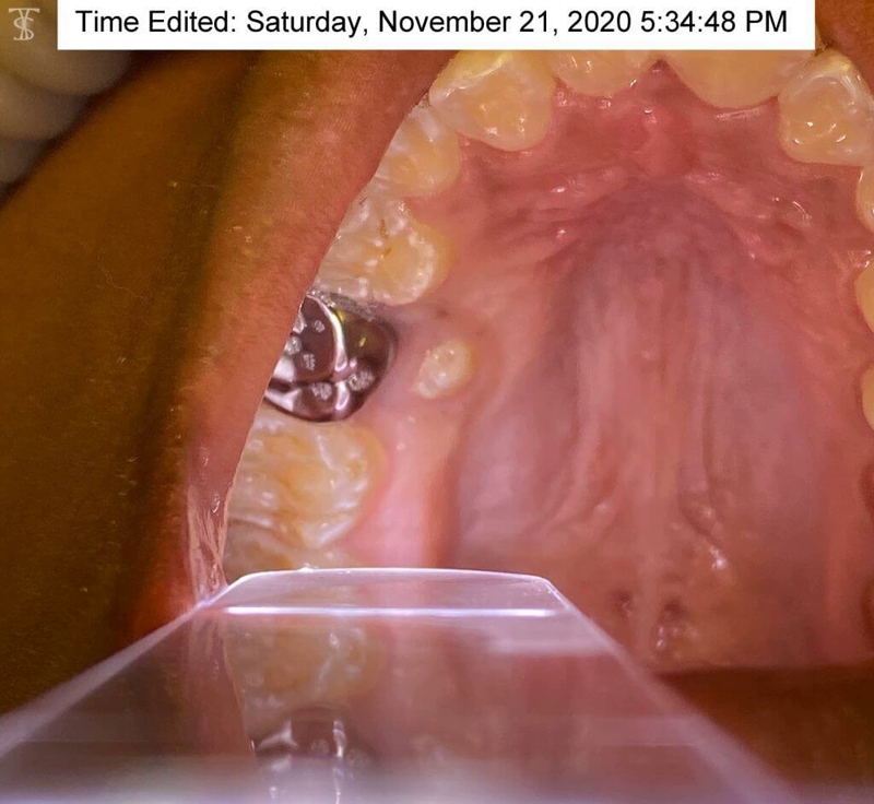 permanent tooth eruption