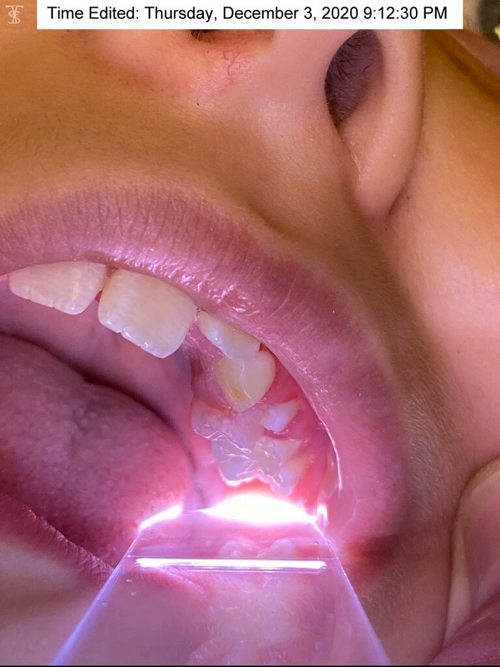 Pink tooth