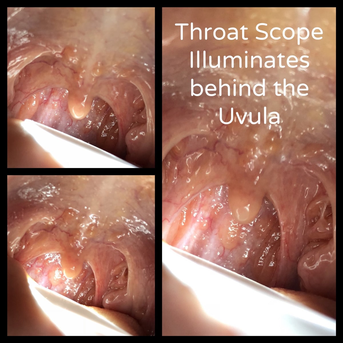 Throat Scope illuminating the inside of a patient's mouth