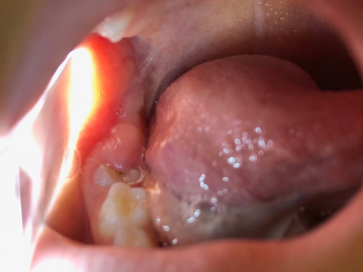 Throat Scope illuminating the inside of a patient's mouth